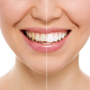 Picture of a woman smiling with half of teeth discolored yellow and the other half bright white | Teeth Whitening Treatment | Cornerstone Dental | Martinsburg WV