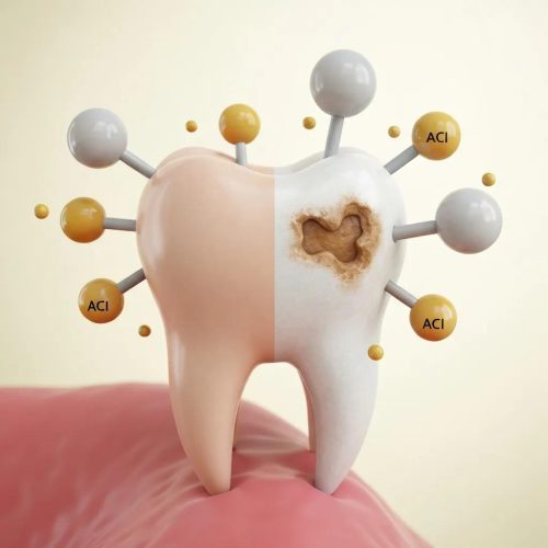 Close-up of a tooth illustrating the effects of sugar and acid on dental health | Oral Health | Cornerstone Dental, Martinsburg WV